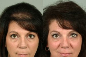 Female-hair-transplant-cleveland-5-small female hair loss