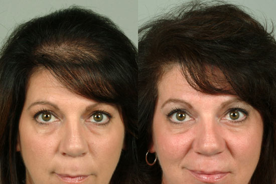 Female-hair-transplant-cleveland-5-small female hair loss