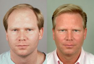 Hair-transplant-cleveland-5-small hair restoration surgery