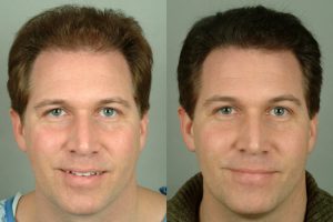 Hair-transplant-cleveland-6-small hair transplant surgery