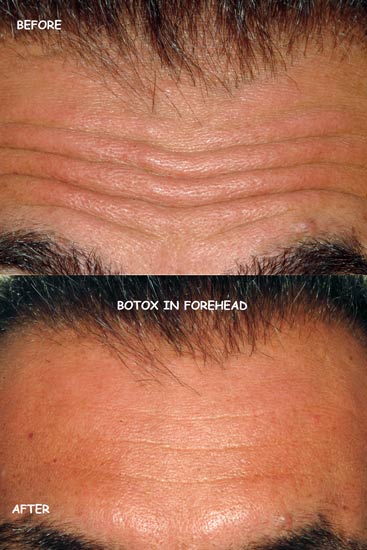 Botox forehead wrinkles