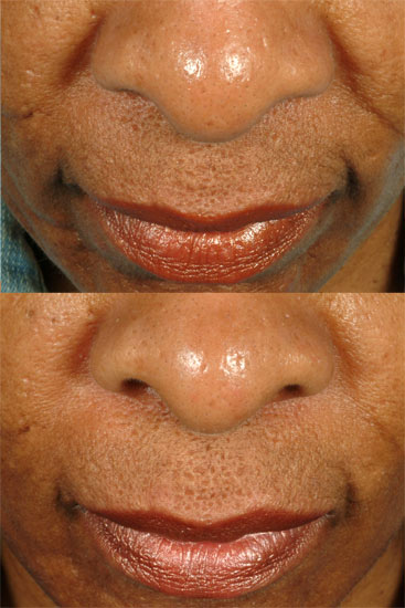 line treatment face