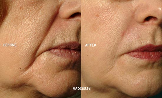filler face line removal
