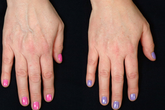 cosmetic procedure wrinkles