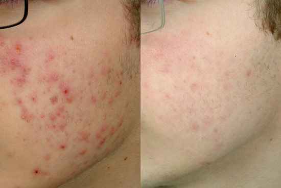 acne treatment face