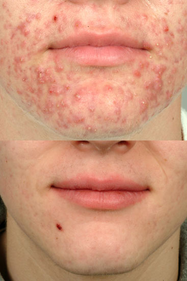 acne treatment cleveland
