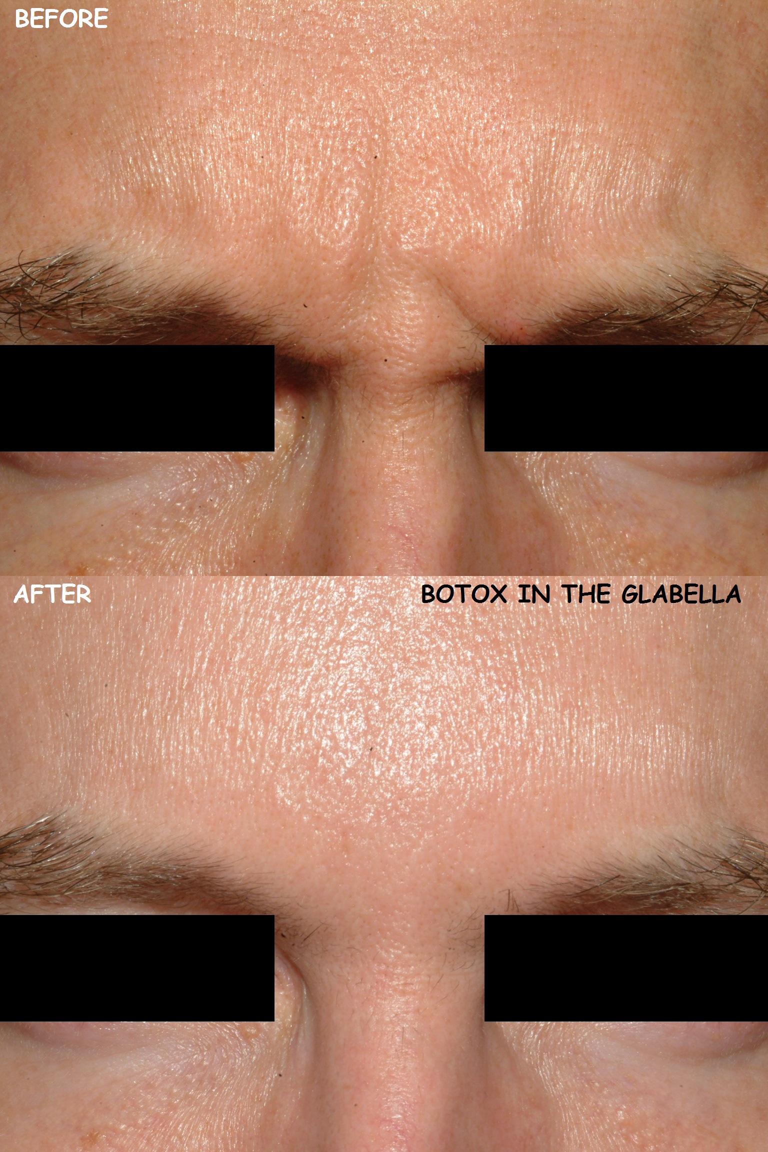 Botox 11