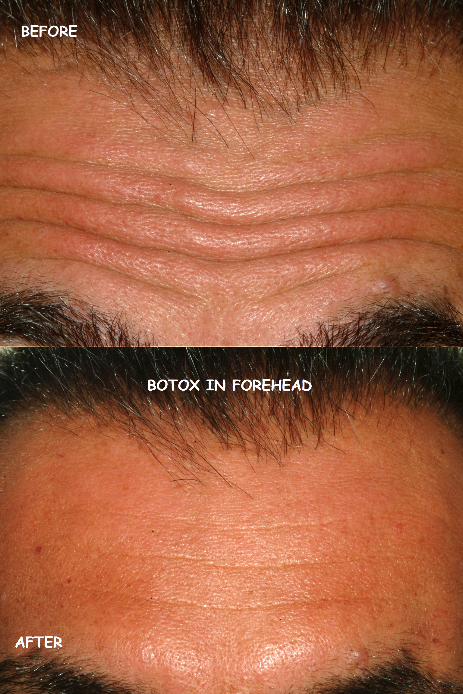 Botox 16 forehead