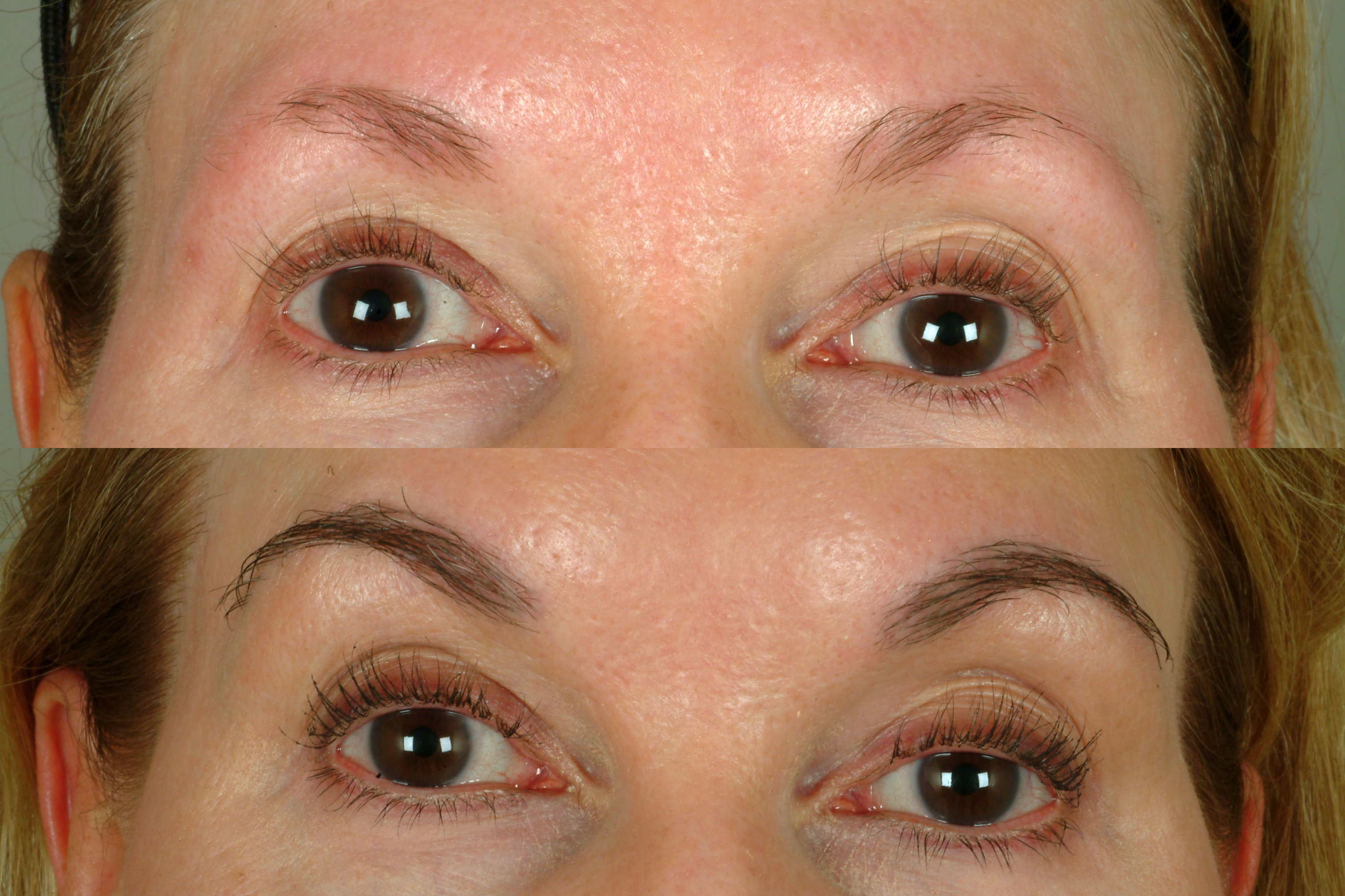 Website Eyebrow Transplant 1