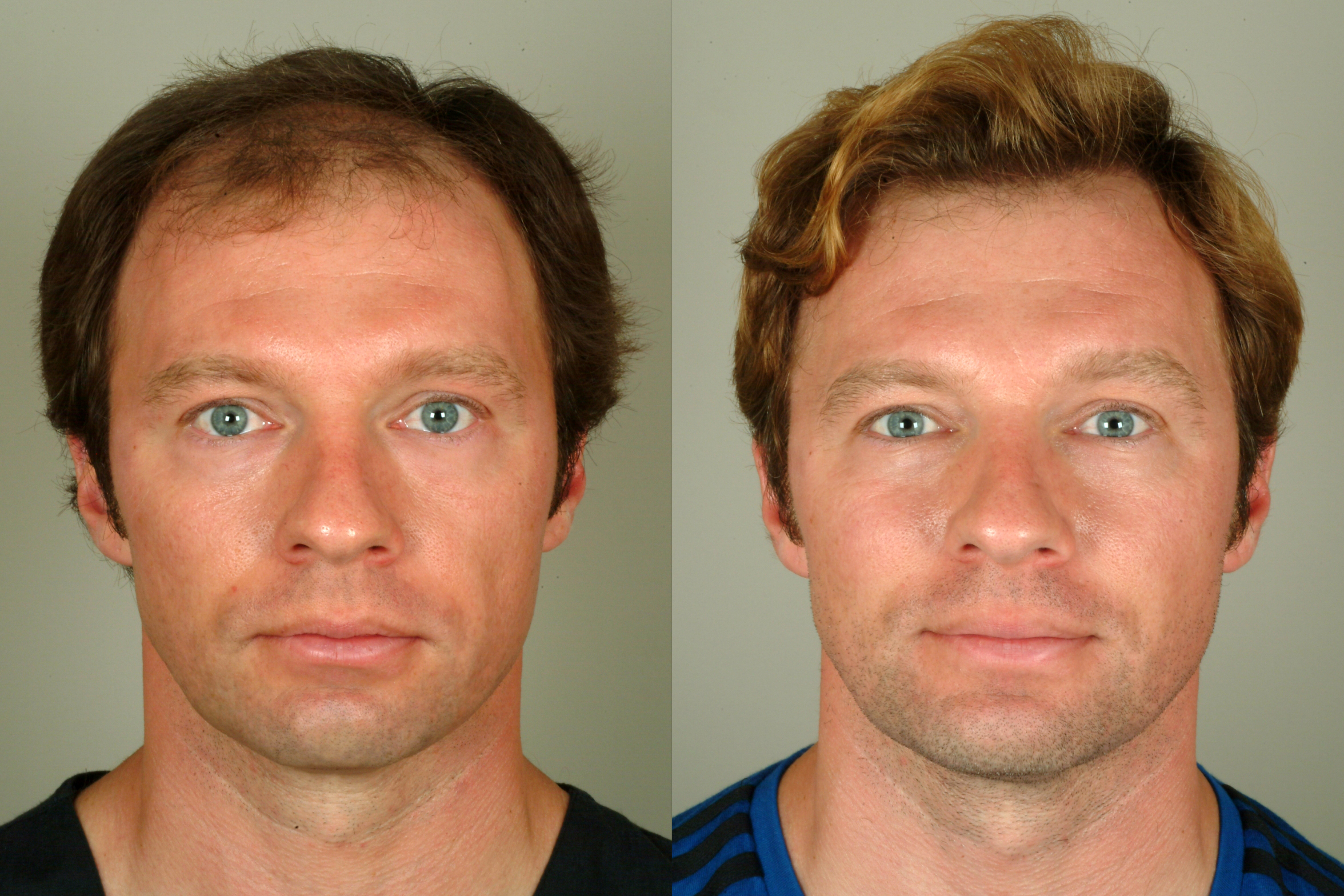 Clevaland Hair Transplants - Before and After - Dr. Haber