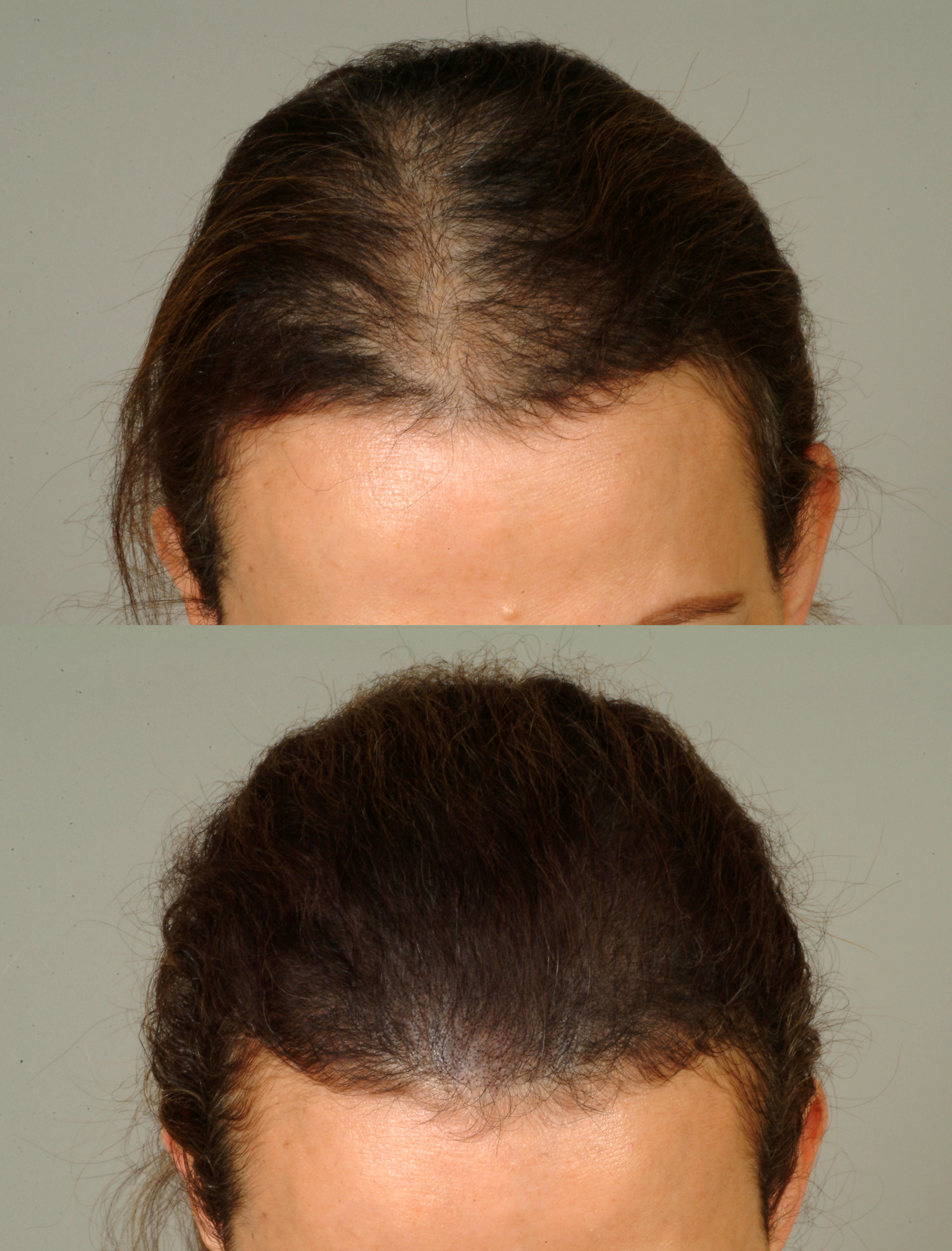 hair loss female cleveland hair restoration