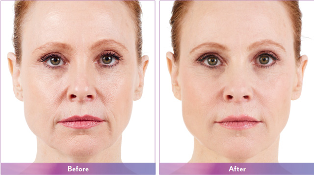 Juvederm Vollure® Xc Haber Dermatology 5673