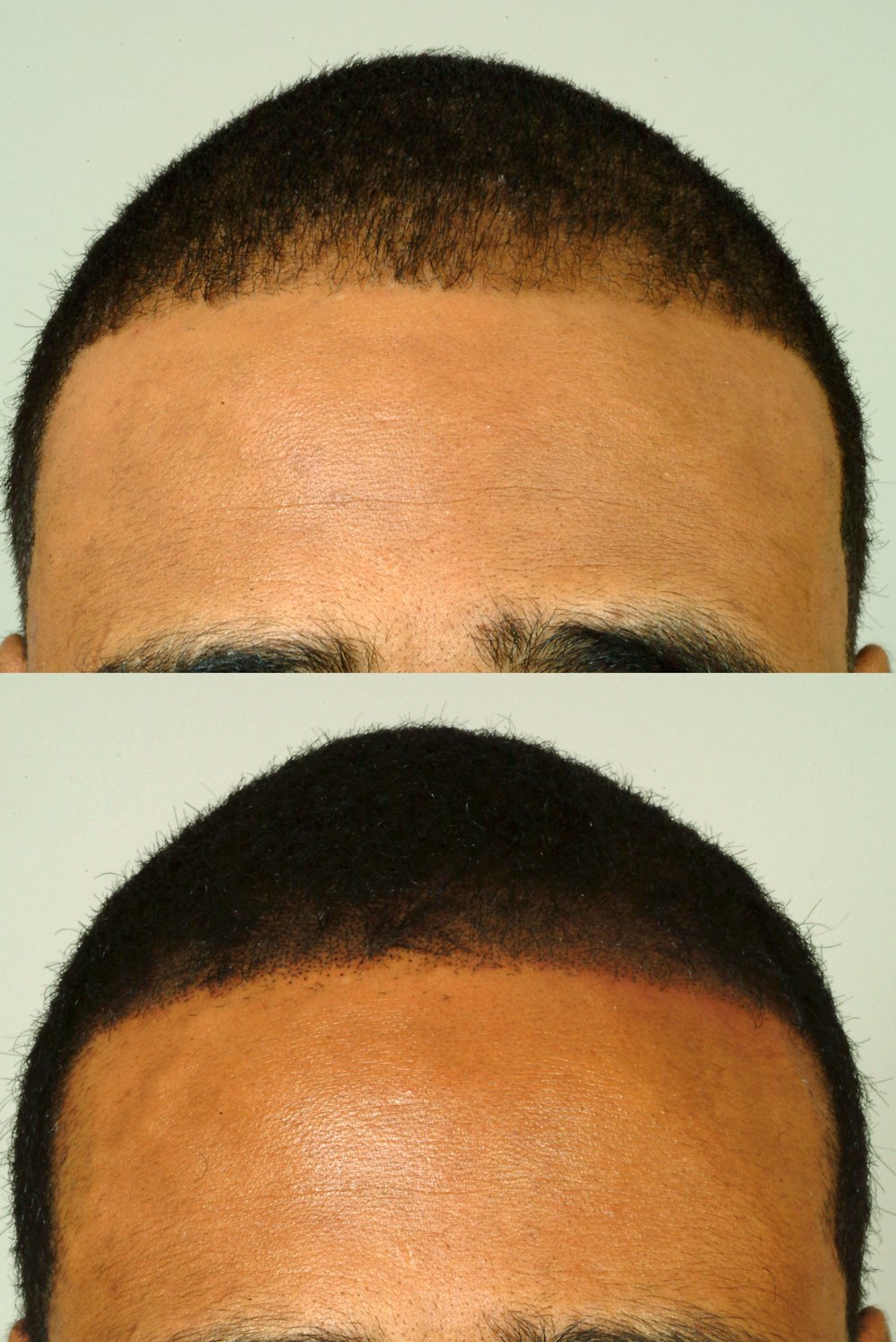 scalp micro pigmentation hair