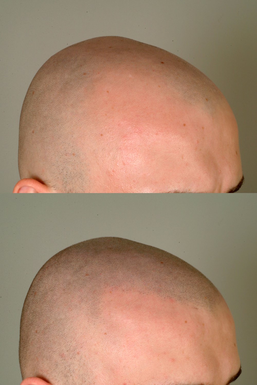 SMP procedure cleveland