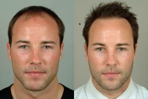 cleveland hair transplant