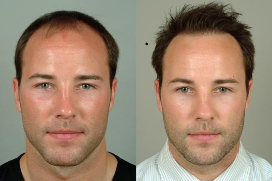 cleveland hair transplant