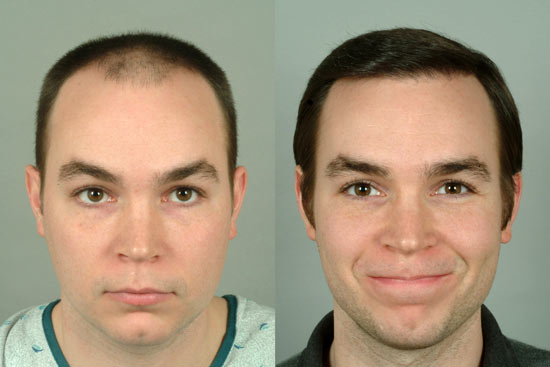 Hair-transplant-cleveland-7-small Hair-restoration-cleveland-7-small