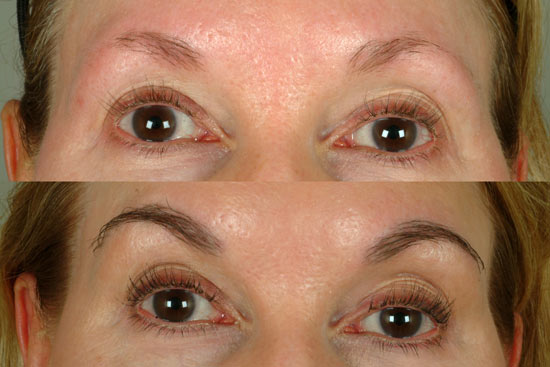 Female Hair Transplant Cleveland