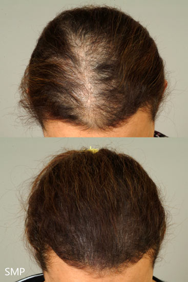 hair loss female Cleveland Female