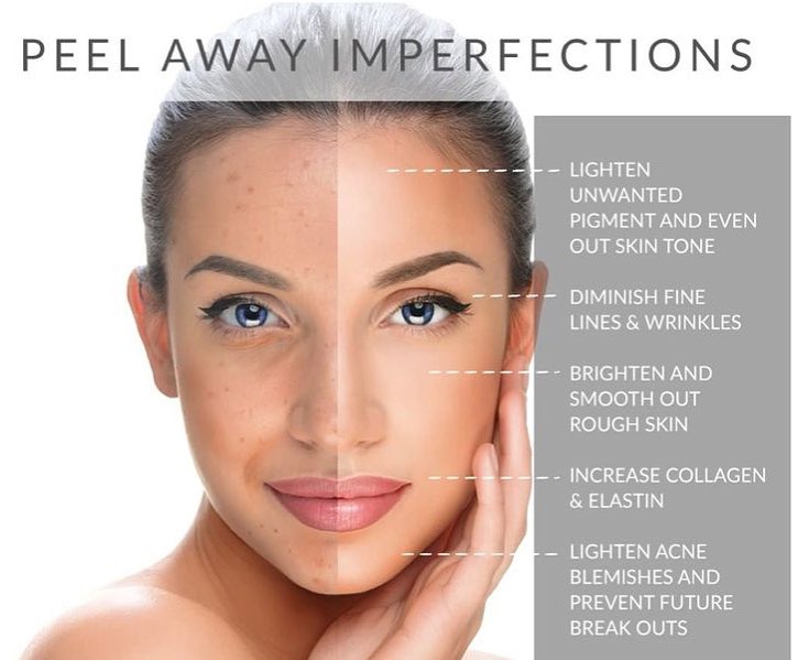 body chemical peels