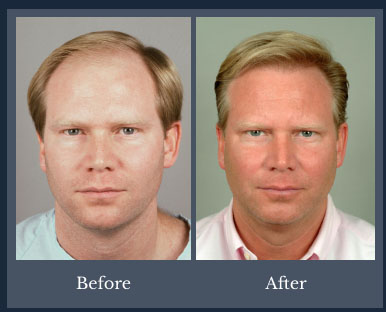 patient with restored hair density 