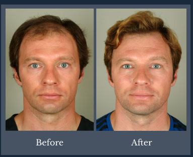 patient with restored hair line