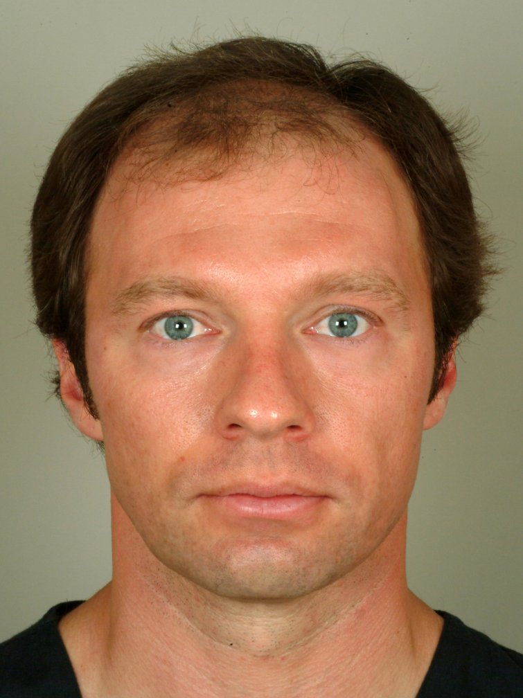 hair transplant before image