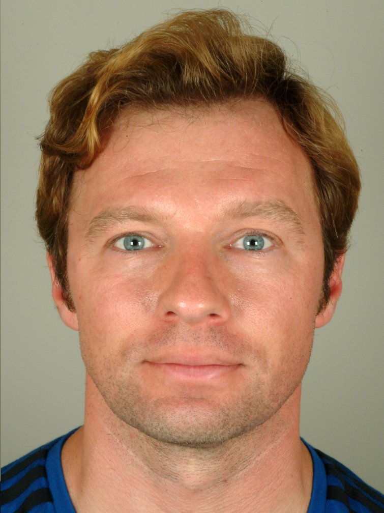 hair transplant after image