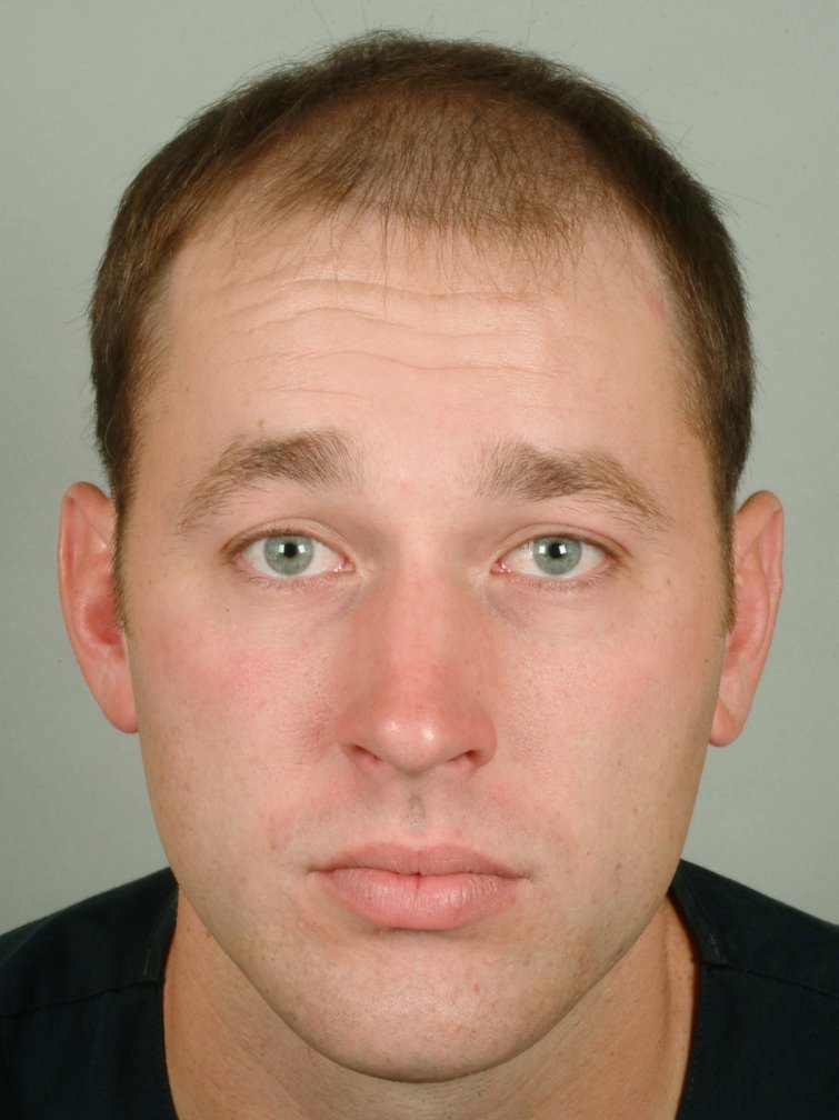 hair transplant after