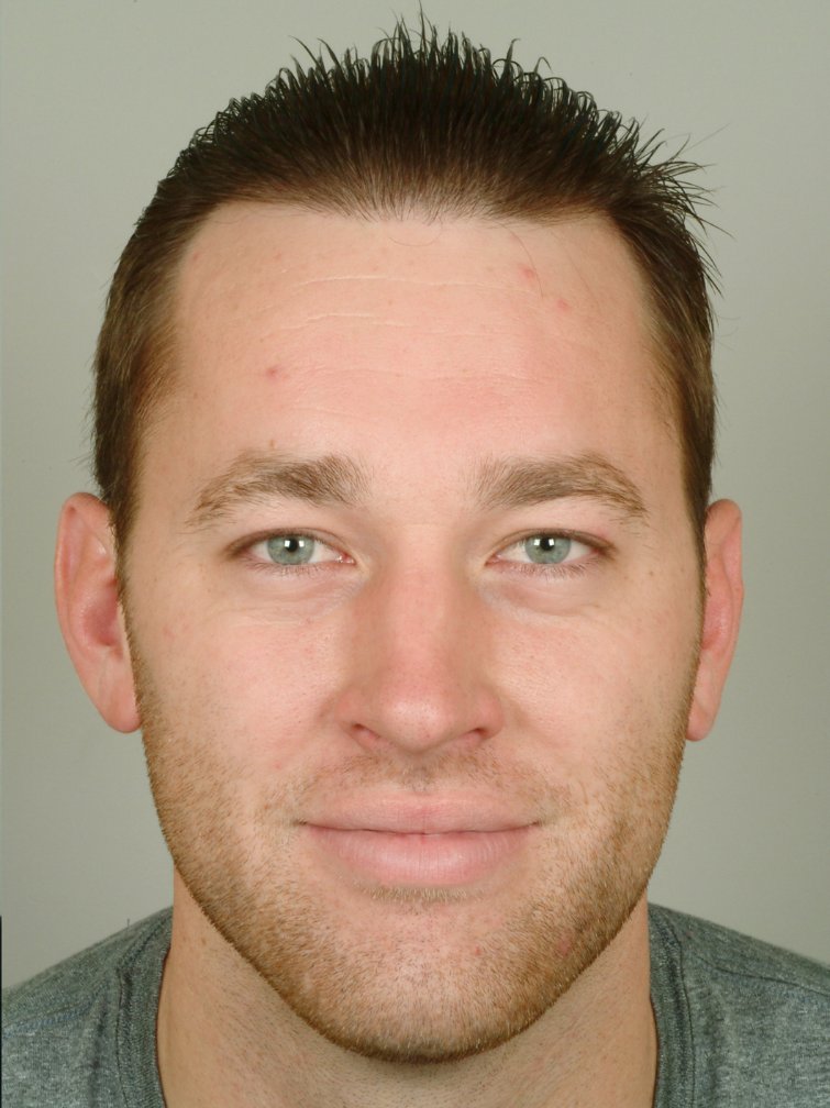 hair transplant after