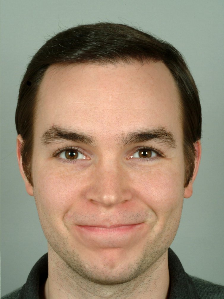 hair transplant after