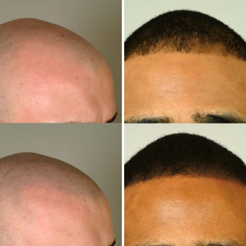 scalp micro pigmentation treatment in cleveland