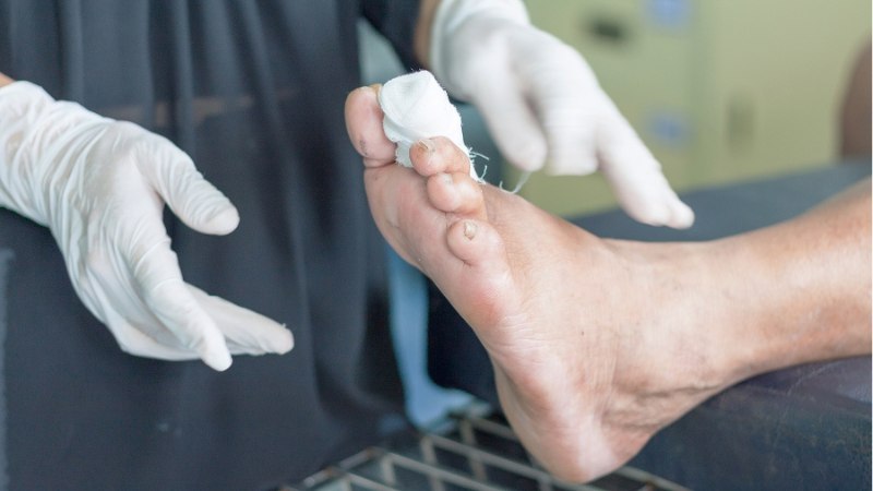 Vitiligo before and after treatment in cleveland