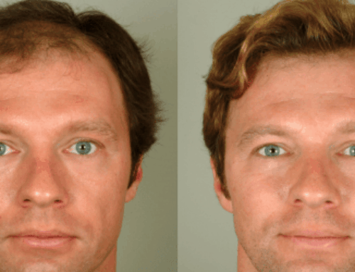 Do Hair Transplants Always Work?