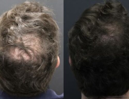 Alma TED for Hair Thinning: Complete Treatment Guide