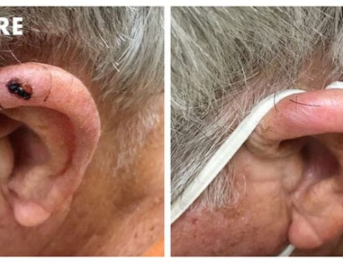 Image Guided Superficial Radiation: A Complete Guide to Non-Surgical Skin Cancer Treatment
