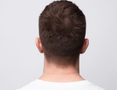Hair Transplant: How Long Does It Last?