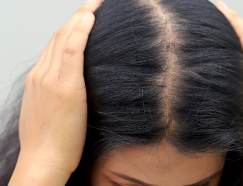 Scarring Hair Loss in Women