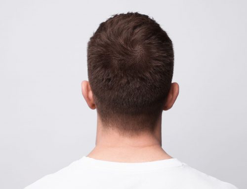 Will My Hair Transplant Last Forever? Here’s the Honest Answer