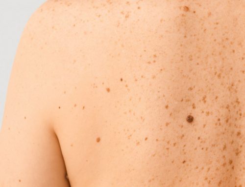 What Is the Difference Between Basal Cell and Squamous Cell Skin Cancer, and How Is It Treated?