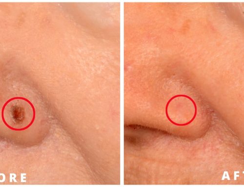 What Are the Skin Cancer Treatment Options Available Today?