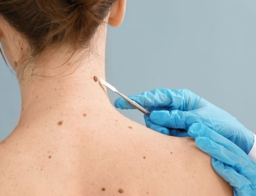 Radiation Therapy for Skin Cancer: How Many Treatments and What to Expect