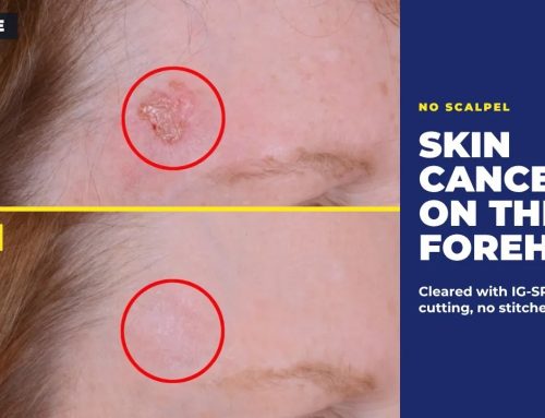3 Skin Cancers, Cheek to Leg, Treated Without a Single Cut